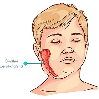 graphic of boy with swollen parotin gland