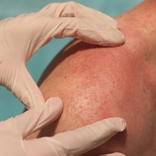 gloved hands examining rash on shoulder